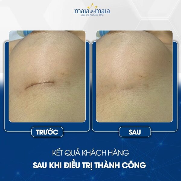 cong-nghe-laser-co2-trong-dieu-tri-seo-6