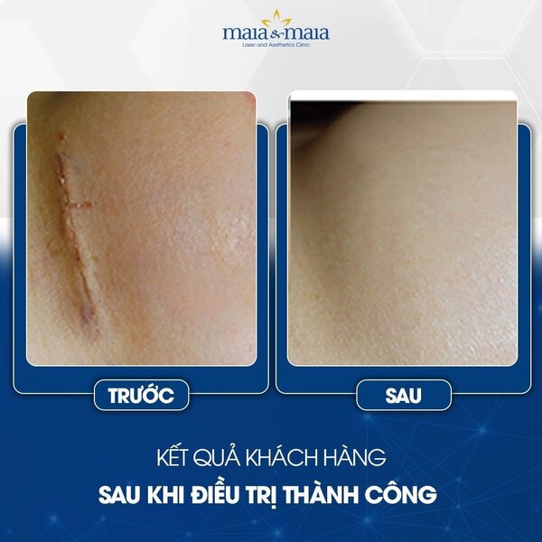 cong-nghe-laser-co2-trong-dieu-tri-seo-7