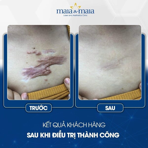 cong-nghe-laser-co2-trong-dieu-tri-seo-8