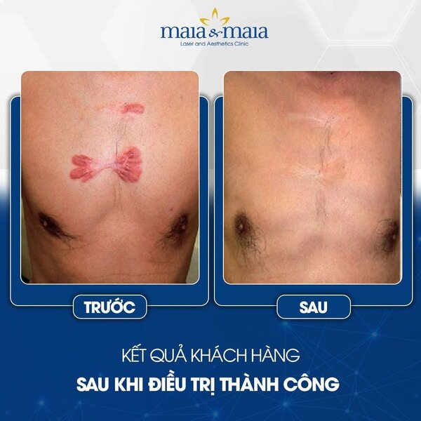 cong-nghe-laser-co2-trong-dieu-tri-seo-9