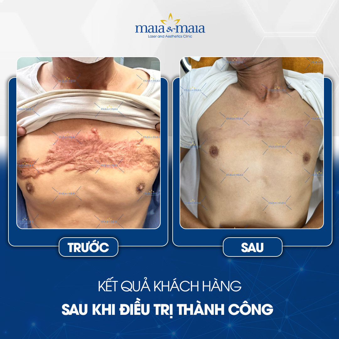 phuong-phap-dieu-tri-seo-11