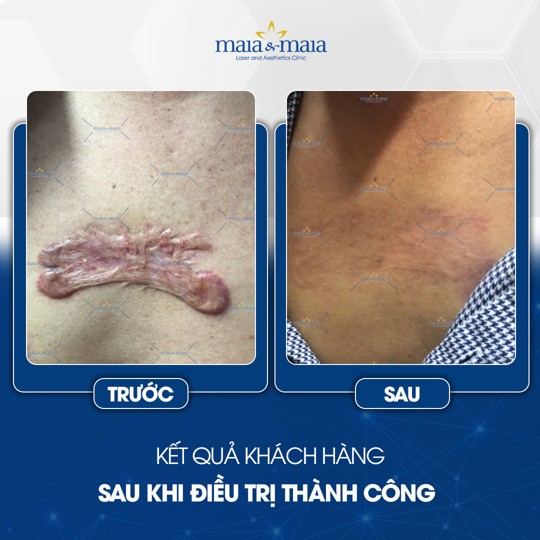 phuong-phap-dieu-tri-seo-12