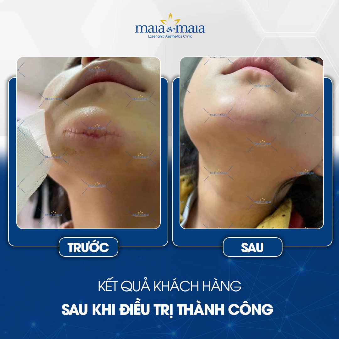 phuong-phap-dieu-tri-seo-8
