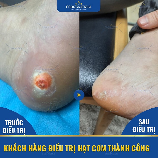 Hiệu quả hỗ trợ điều trị hạt cơm tại phòng khám Hiệu quả hỗ trợ điều trị hạt cơm tại phòng khám