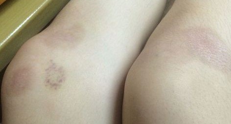 Sẹo thâm sau tai nạn ở chân Sẹo thâm sau tai nạn ở chân