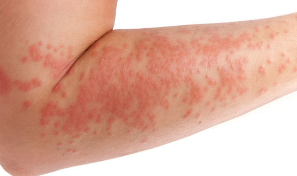 Hình ảnh: Bệnh chàm eczema
