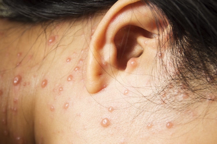 Hình ảnh bệnh thủy đậu Hình ảnh bệnh thủy đậu
