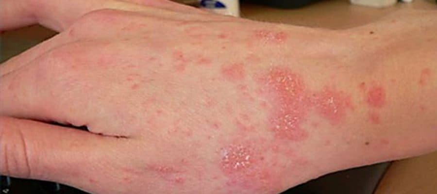 Hình ảnh: Bệnh ghẻ