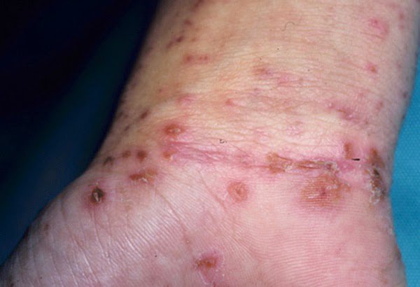 Hình ảnh: Bệnh ghẻ