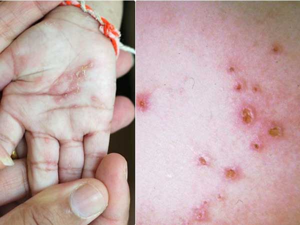 Hình ảnh: Bệnh ghẻ ở trẻ em
