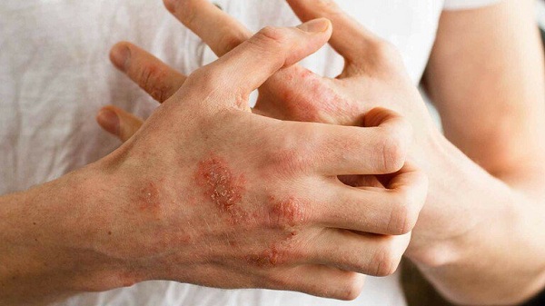 Viêm da cơ địa ở người lớn Viêm da cơ địa ở người lớn