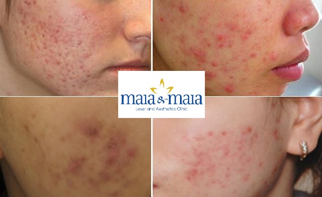HÌNH ẢNH MỤN TẠI pk CHUYÊN KHOA DA LIỄU MAIA DA MỤN