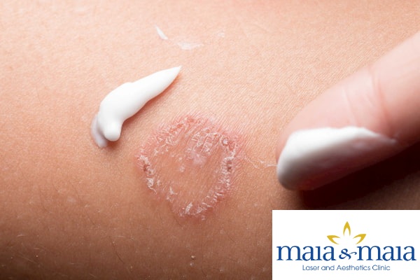 Bệnh nấm da và phương pháp hỗ trợ điều trị Nấm da