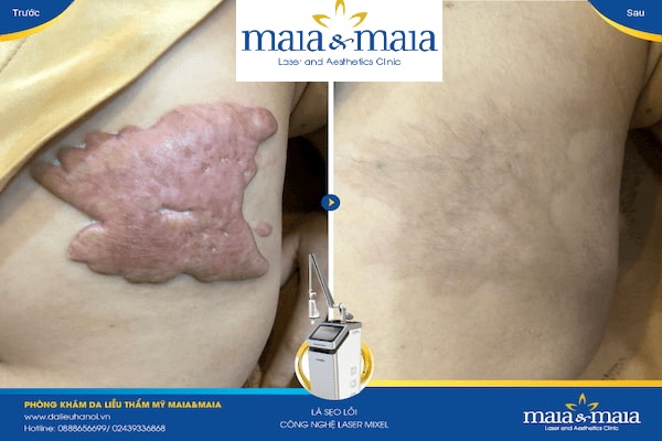 Hình ảnh : trước và sau khi điều trị sẹo lồi tại PK Maia&Maia Hình ảnh : trước và sau khi điều trị sẹo lồi tại PK Maia&Maia