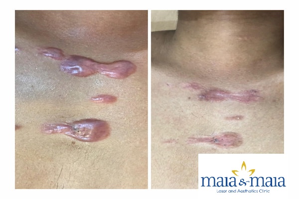 Hình ảnh : trước và sau khi điều trị sẹo lồi tại PK Maia&Maia Hình ảnh trước và sau khi điều trị sẹo lồi