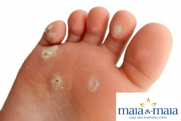 Hạt cơm mụn cóc lòng bàn chân Hạt cơm mụn cóc lòng bàn chân