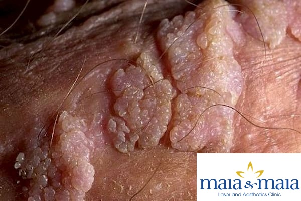Hình ảnh hạt cơm- mụn cóc vùng sinh dục Hạt cơm- mụn cóc vùng sinh dục