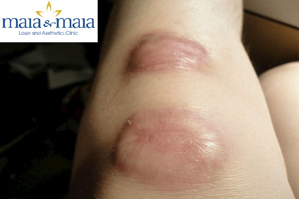 Hình ảnh : sẹo lồi ở chân của bệnh nhân tại pk chuyên khoa Da liễu Maia Hình ảnh : sẹo lồi ở chân của bệnh nhân