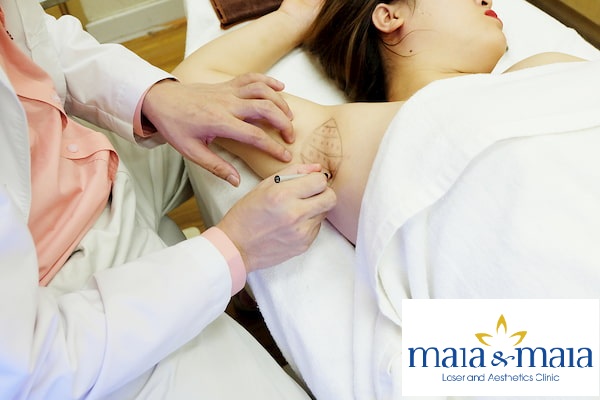 Hình ảnh : Thạc sỹ - Bác sĩ Nguyễn Văn Hoàn hỗ trợ điều trị thâm nách tại PK Maia&Maia Hình ảnh : Thạc sỹ - Bác sĩ Nguyễn Văn Hoàn hỗ trợ điều trị thâm nách tại PK Maia&Maia