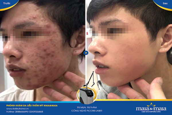 Hình ảnh: Sau khi hỗ trợ điều trị lấy nhân mụn bằng phương pháp Laser DIOT