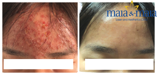 Hình ảnh: Sau khi hỗ trợ điều trị mụn trứng cá bằng công nghê Laser DIOT Hình ảnh: Sau khi hỗ trợ điều trị mụn trứng cá bằng công nghê Laser DIOT