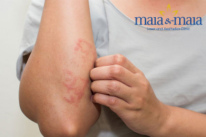 Hình ảnh: Viêm da tiếp xúc dị ứng