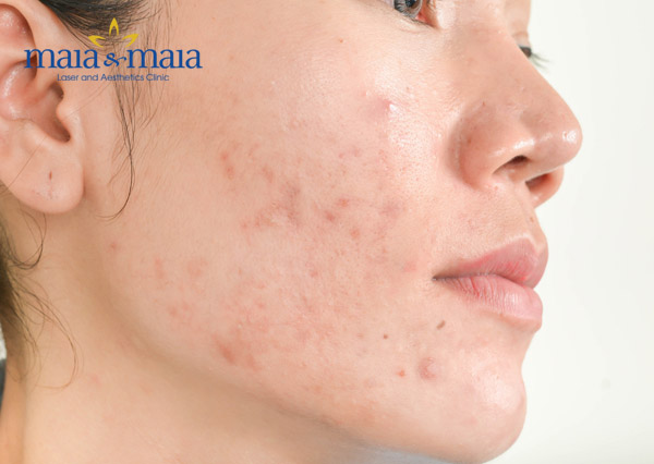 Đừng quên trị thâm mụn Đừng quên trị thâm mụn