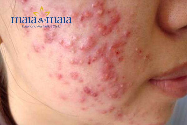 Mụn trứng cá cụm Mụn trứng cá cụm