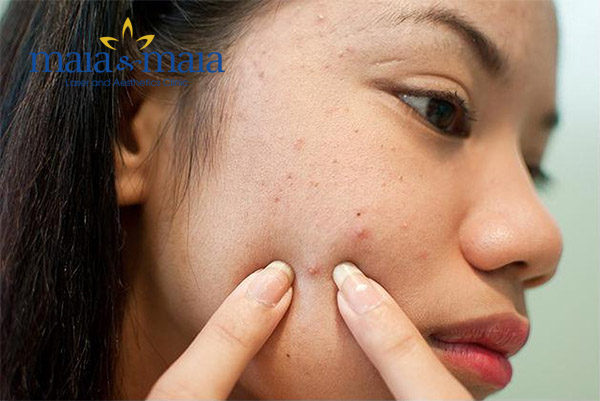 Nặn mụn sai cách gây tình trạng mụn nặng hơn Nặn mụn sai cách gây tình trạng mụn nặng hơn