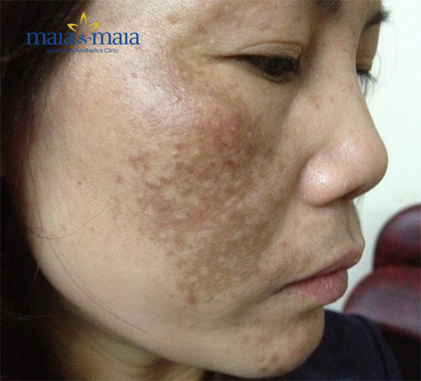 Nám mảng Nám mảng