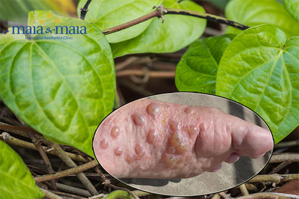 Chữa bệnh tổ đỉa bằng lá trầu không Chữa bệnh tổ đỉa bằng lá trầu không