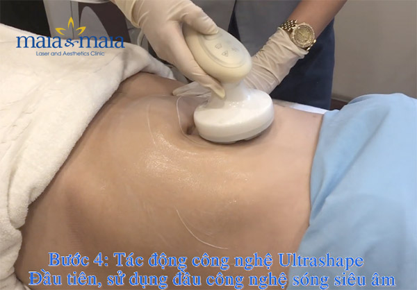 Giảm béo bụng bằng công nghệ Ultrashape Giảm béo bụng bằng công nghệ Ultrashape