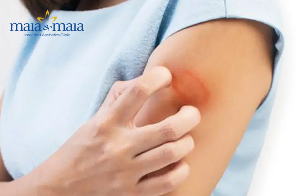 Bệnh hắc lào gây ngứa ngáy khó chịu Bệnh hắc lào gây ngứa ngáy khó chịu
