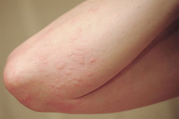 Hiện tượng nổi mề đay sau sinh Hiện tượng nổi mề đay sau sinh