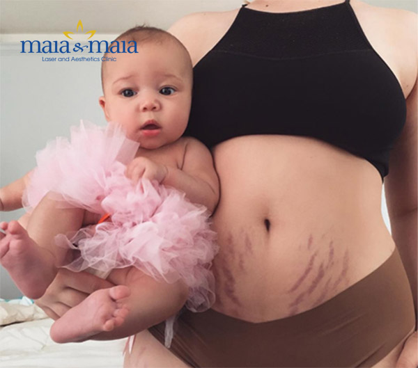 Rạn da sau sinh - Sai lầm vì điều trị sai phương pháp Rạn da sau sinh - Sai lầm vì điều trị sai phương pháp