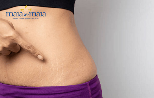 Rạn da hình thành do mạng lưới collagen và elastin bị đứt gãy Rạn da hình thành do mạng lưới collagen và elastin bị đứt gãy