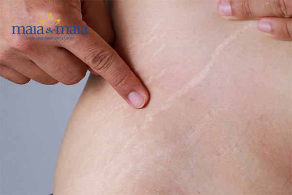 Vết rạn vẫn nằm dai dẳng trên da do chưa tìm được công nghệ phù hợp Vết rạn vẫn nằm dai dẳng trên da do chưa tìm được công nghệ phù hợp