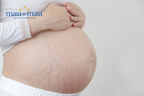 Rạn da thường xảy ra ở tháng thứ 4 thai kì hoặc ở cuối thai kì Rạn da thường xảy ra ở tháng thứ 4 thai kì hoặc ở cuối thai kì