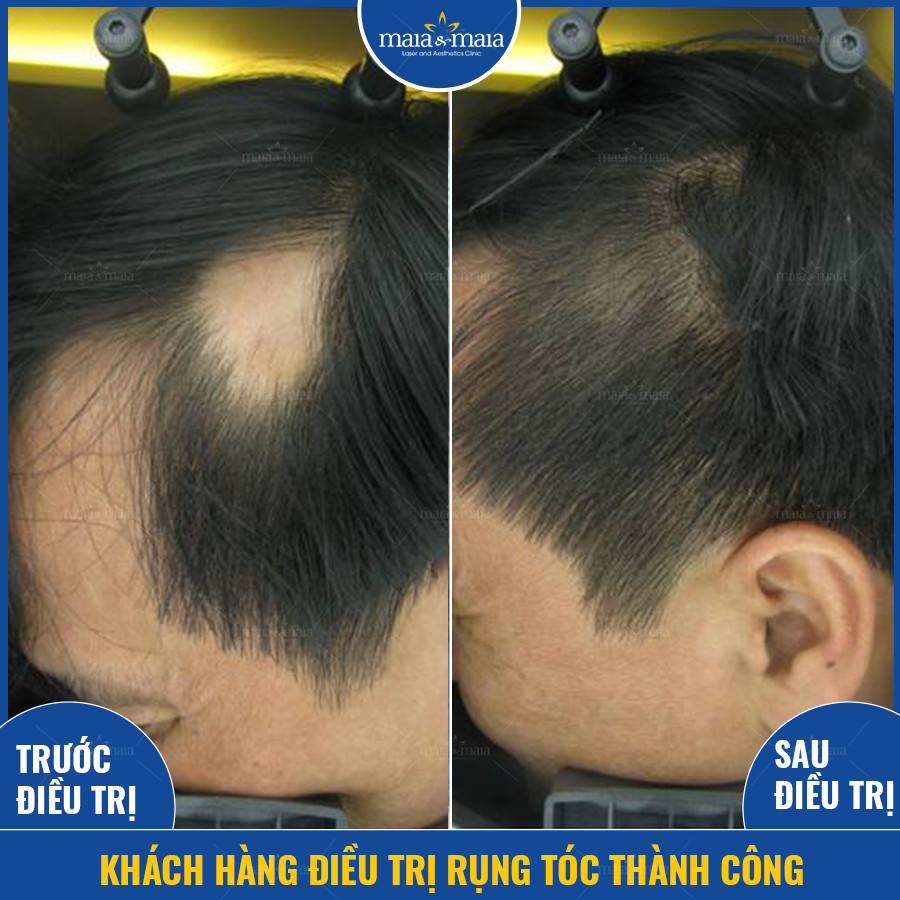 Hình ảnh khách hàng điều trị rụng tóc thành công Hình ảnh khách hàng điều trị rụng tóc thành công