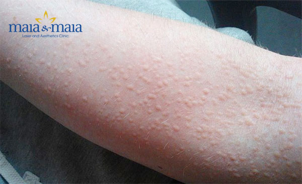 Mề đay cholinergic Mề đay cholinergic
