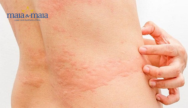 Khi bị nổi mề đay không nên gãi ngứa Khi bị nổi mề đay không nên gãi ngứa