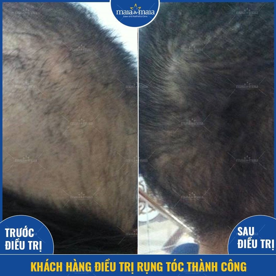 Hình ảnh khách hàng điều trị rụng tóc thành công Hình ảnh khách hàng điều trị rụng tóc thành công