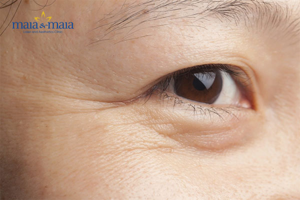 Nếp nhăn vùng mắt Nếp nhăn vùng mắt