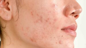 Điều trị bằng hoạt chất BHA, AHA, Retiol có an toàn không?