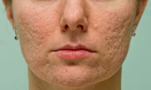 Sẹo rỗ khiến làn da bị ảnh hưởng tới thẩm mỹ rất lớn