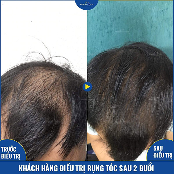 Kết quả hỗ trợ điều trị rụng tóc, hói đầu tại phòng khám Kết quả hỗ trợ điều trị rụng tóc, hói đầu tại phòng khám