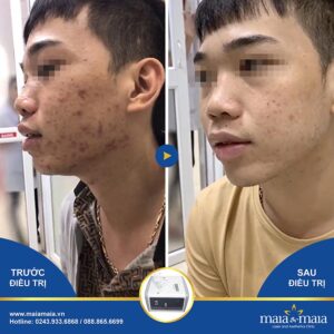 Yếu tố hình thành nên mụn trứng cá