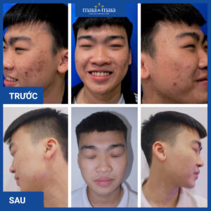 Mụn trứng cá thường xuất hiện ở tuổi dậy thì