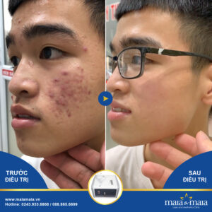 Mụn trứng cá đều xuất hiện ở cả nam và nữ rất nhiều