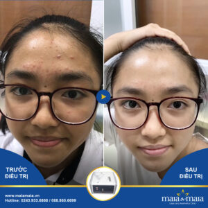 Các chủng tộc khác nhau chịu sự ảnh hưởng khác nhau trên sự hình thành mụn trứng cá